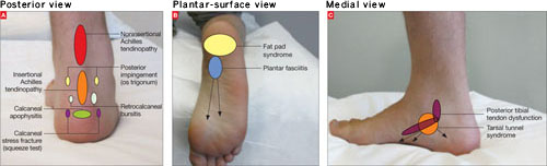 plantar-fasciitis-what-it-is-and-how-to-treat-it-praxis-health